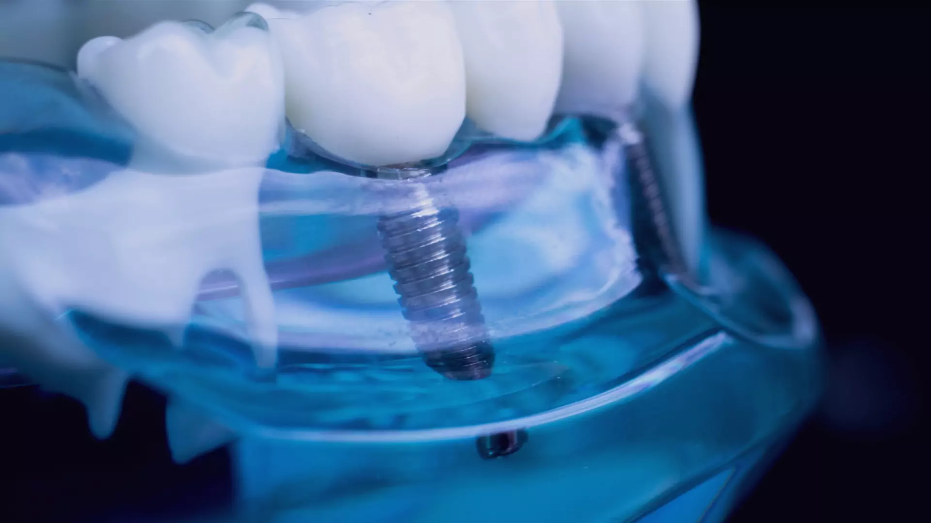 Regeneración ósea previa a la instalación de implantes dentales: revisión de la evidencia