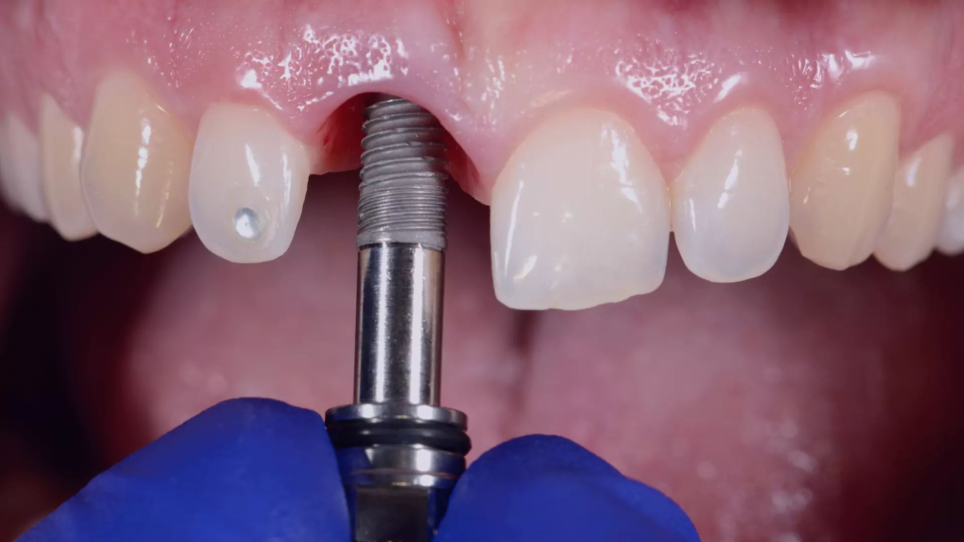 Rehabilitación oral estética en dientes con atrición y restablecimiento de dimensión vertical: Reporte de caso.