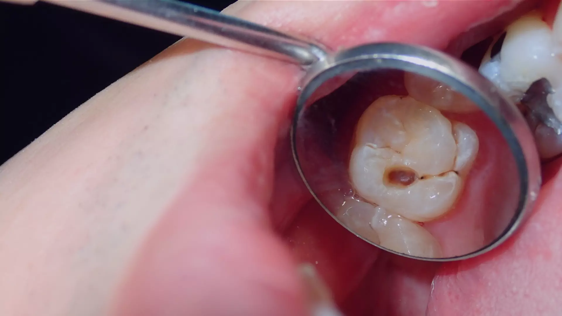 Terapias no invasivas en base a fluoruros de alta concentración para lesiones de caries radicular