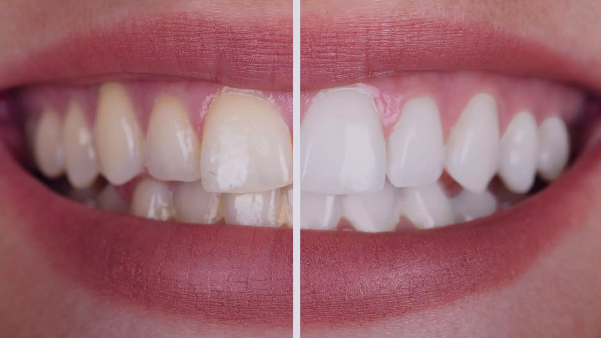 Diagnóstico de pigmentaciones dentales y tratamiento