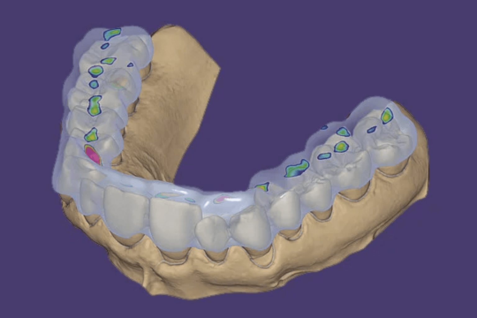 Modelo digital de una restauración dental diseñado con Exocad como referencia al curso de odontología digital organizado por Techdent.